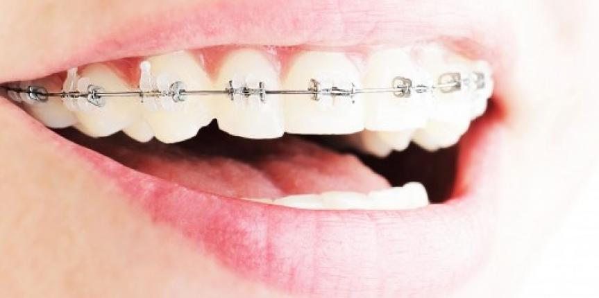 Traitement ostéopathique et orthodontie